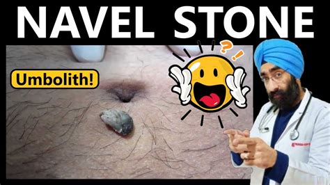 navel stone symptoms|What to Know and Do About Navel Stones